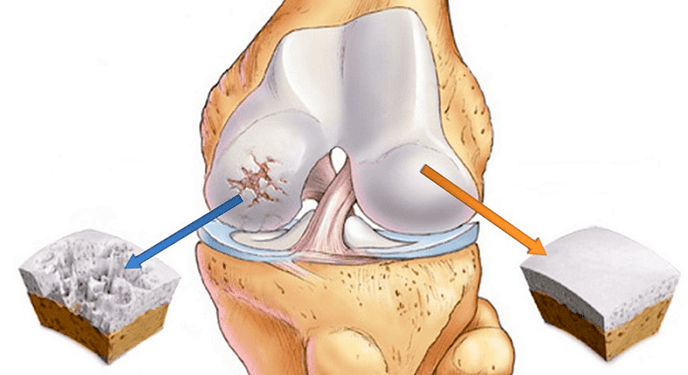 ჯანსაღი ხრტილი და ართროზით დაზარალებული ხრტილი